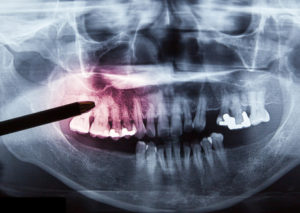 歯科医師がレントゲンでリスクを説明