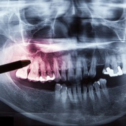 歯科医師がレントゲンでリスクを説明