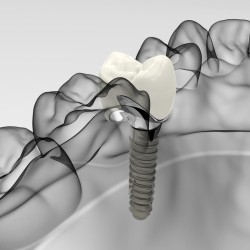歯科インプラントのレントゲン写真